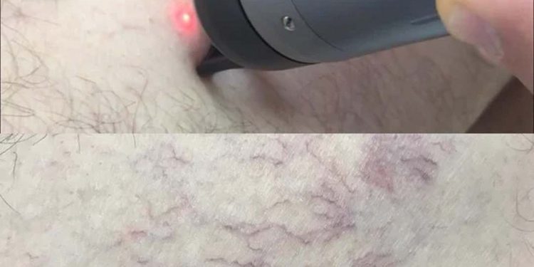 Laser điều trị các tổn thương mạch máu