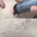 Laser điều trị các tổn thương mạch máu