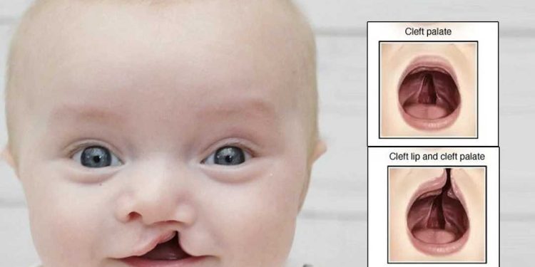 Hình ảnh bé mắc hội chứng Patau