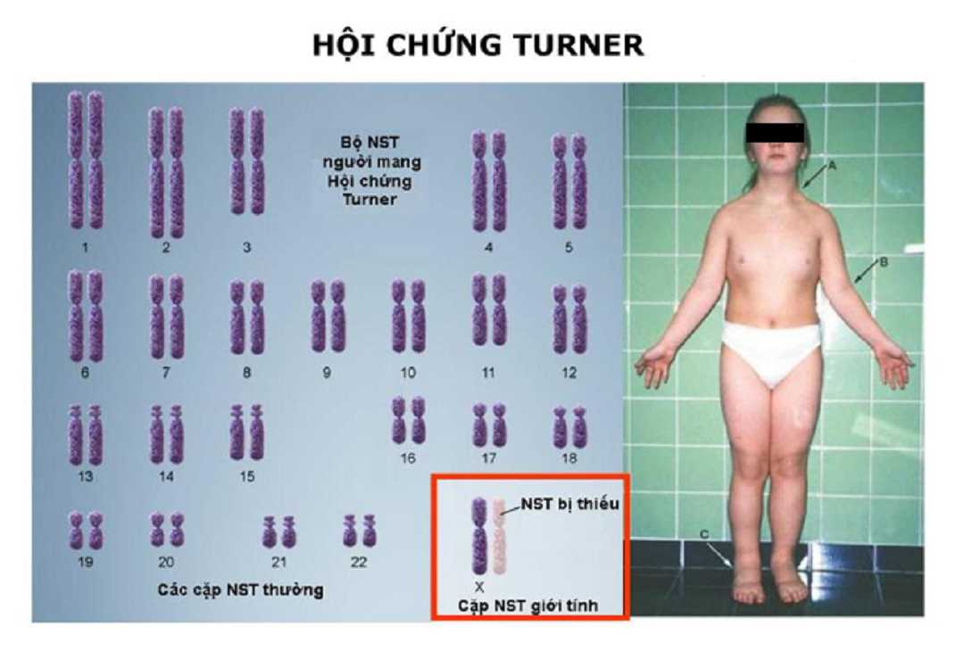 Người mắc hội chứng Turner